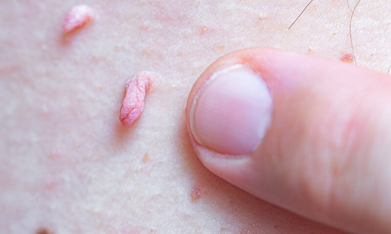 Verrugas Genitales por VPH