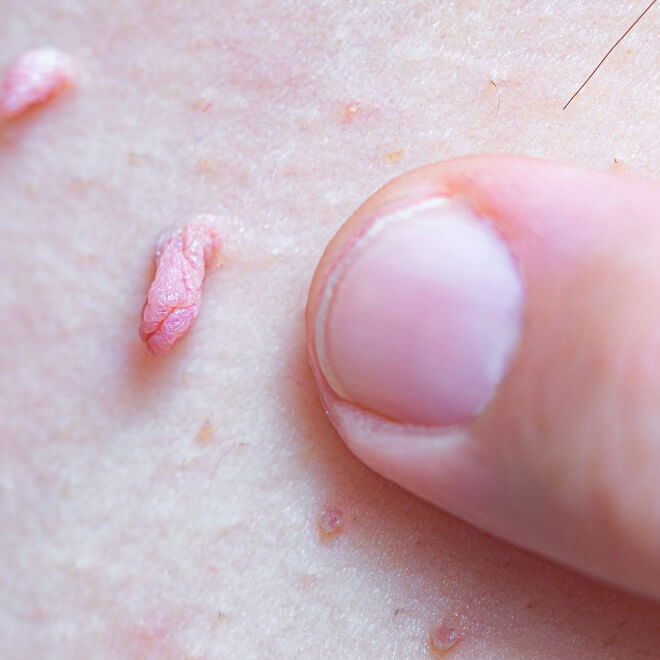 Verrugas Genitales por VPH